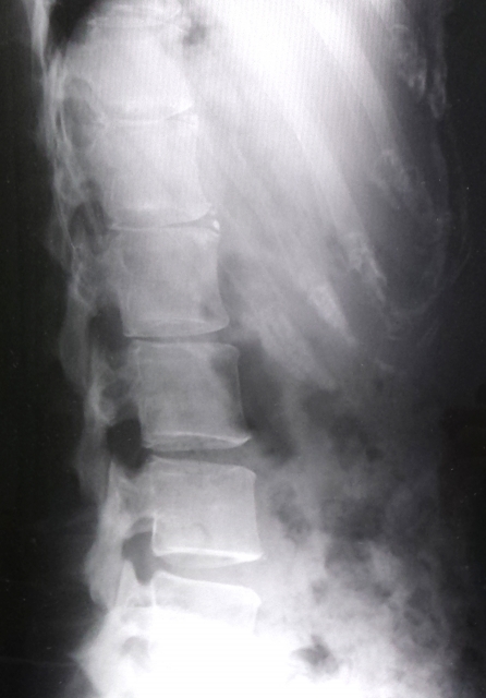 腰椎椎間板ヘルニアレントゲン画像